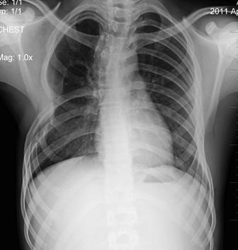 Figure 6: Chest radiograph at six months does not show evidence of residual disease